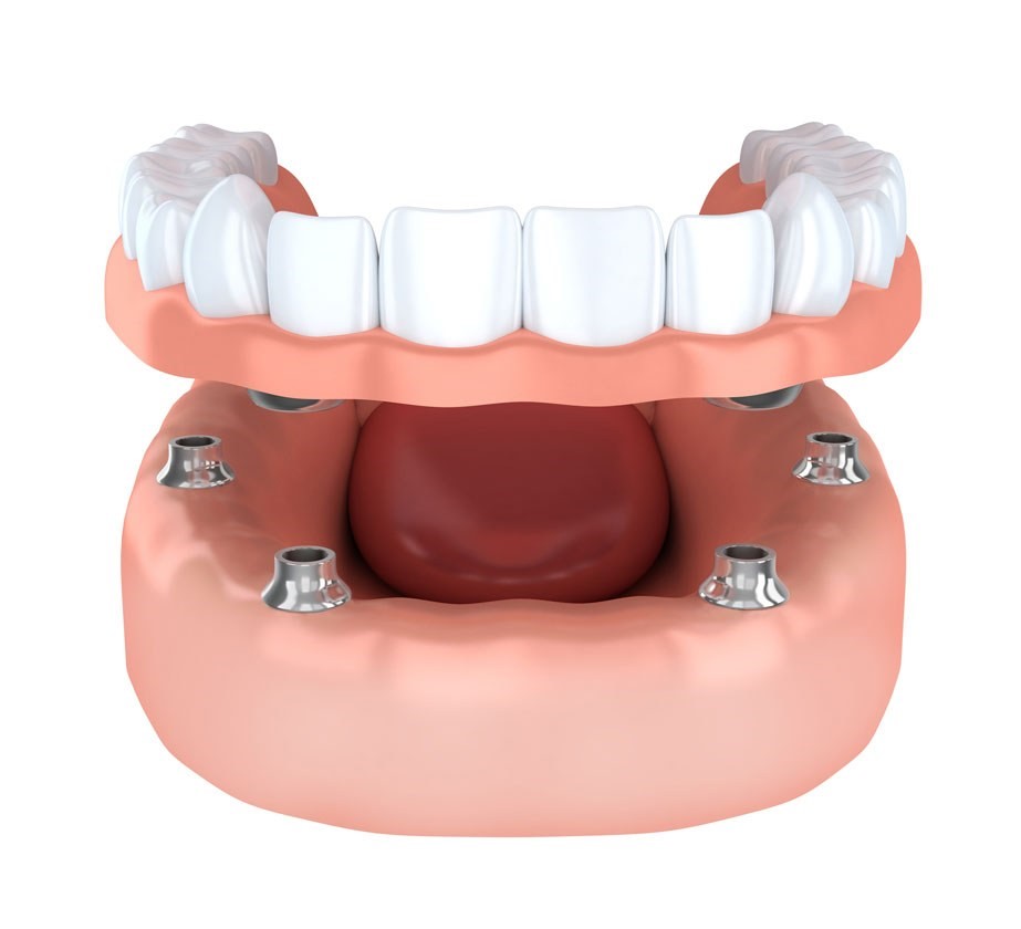 Immediate Dentures Pinole CA 94564